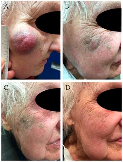 Cancers Free Full Text Merkel Cell Carcinoma New Trends