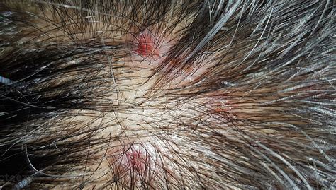 Scabs On The Scalp Wound On The Scalps Or Lichen Planus Follicularis