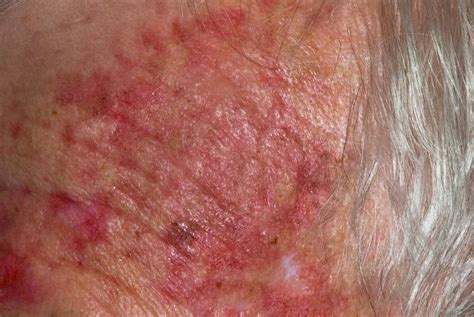 Actinic Keratoses Field Cancerization And Photodynamic Therapy