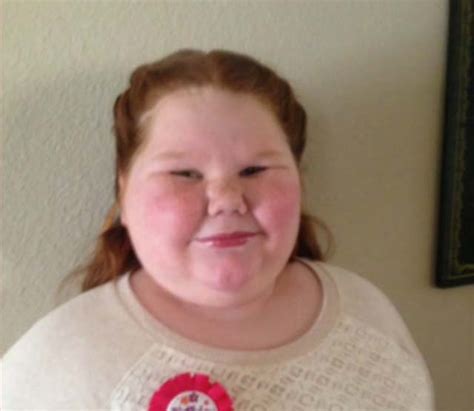 Alexis Shapiro Obese Girl 12 Fights For Gastric Bypass