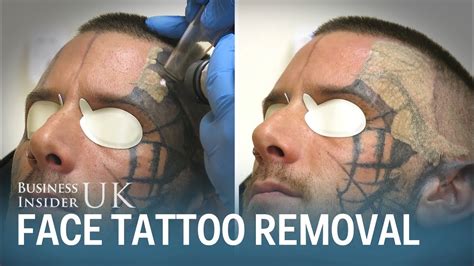 Watch This Man Have His Face Tattoo Removed From Laser Surgery Business