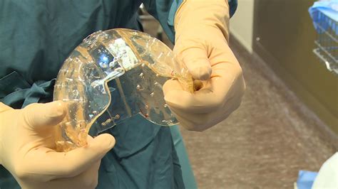 Medical First 3 D Printed Skull Successfully Implanted In Woman Nbc News