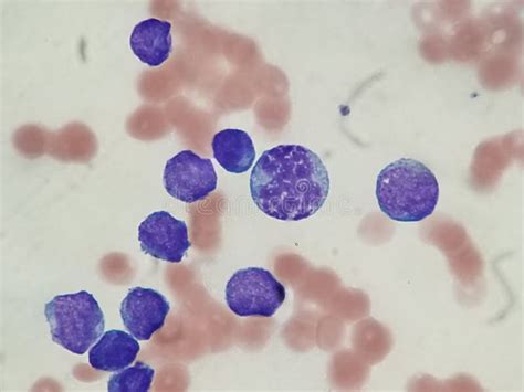Acute Myelocytic Leukemia Seen On Peripheral Blood Smear Stock