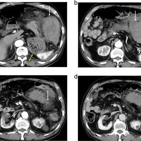 Abdominal Contrast Enhanced Computed Tomography Ct Findings An