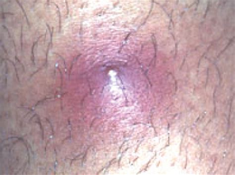 When this happens, the way the. MRSA Skin Infections: Frequently Asked Questions | MomsTeam
