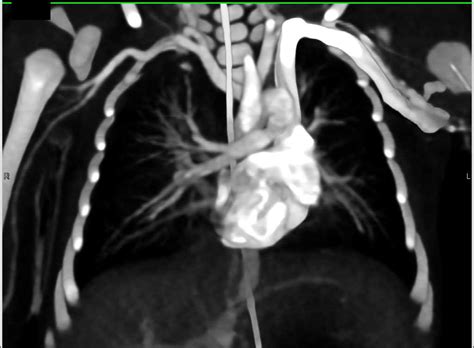 Coarctation Of The Aorta Vascular Case Studies Ctisus Ct Scanning