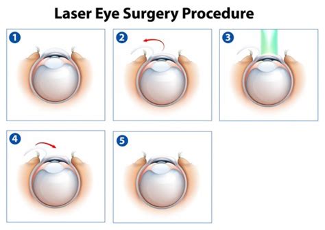 Darts Präsentation Messbar laser eye surgeon boston Abgeschnitten