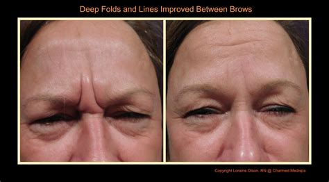 Deep Fold And Wrinkle Improvement Between Brows Charmed Medispa