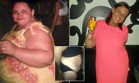 Office Worker Left With Huge Apron Of Saggy Skin After Losing 13st Begs