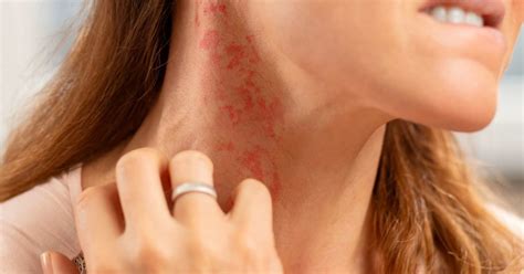 8 Types Of Itchy Rash