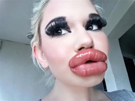 Real Life Barbie Had Her Th Lip Injection But Still Wants Her Lips