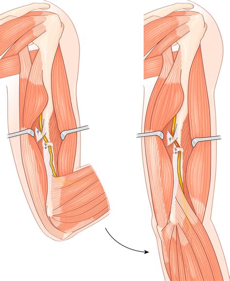 Atraumatic Proximal Radial Nerve Entrapment The Fibrous Arch
