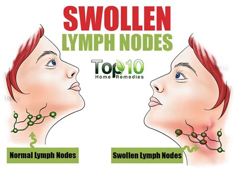Swollen Lymph Nodes And Tonsils