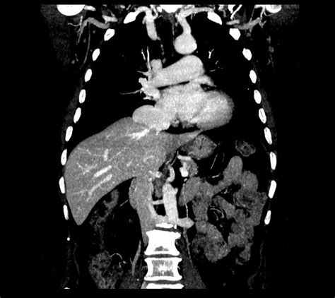 Aneurysm Of The Inferior Vena Cava Image