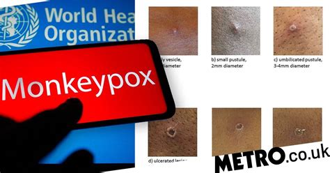 Uk Monkeypox Cases Could Rise Significantly In Next Few Weeks Metro