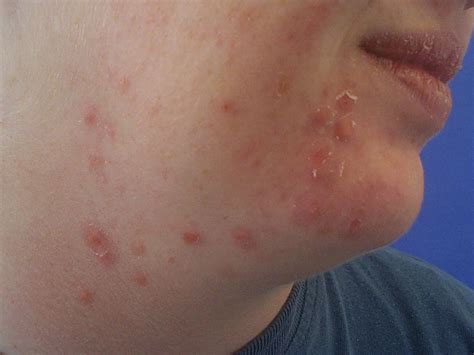 Acne Papules Causes And Treatments