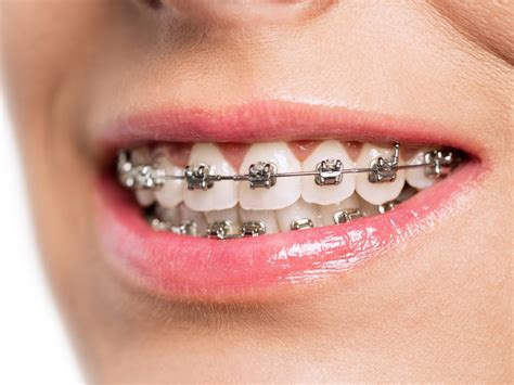 How To Correct Deep Bite With Braces