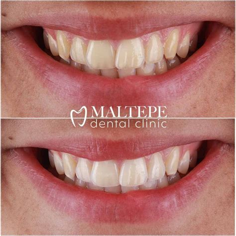 The Versatility Of Dental Lasers From Teeth Whitening To Gum Surgery