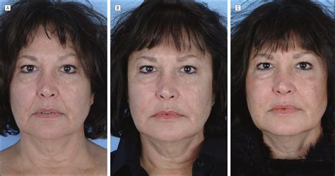 High Volume Calcium Hydroxylapatite Filler To The Lower One Third Of