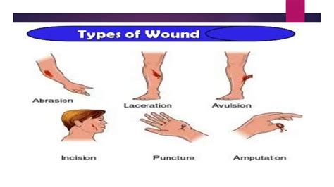 Types Of Wounds And Management