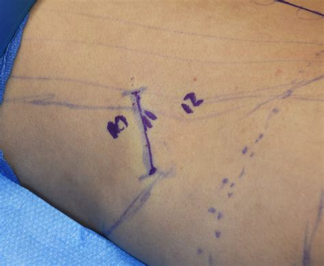 The Anatomic Basis Of Comprehensive Rib Removal Surgery For Waist