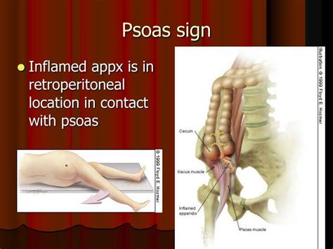 Ppt Appendicitis Powerpoint Presentation Id6769039