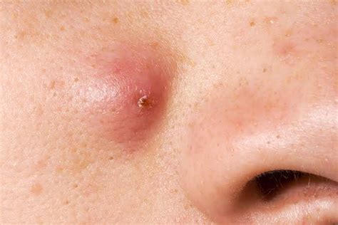 What Is Sebaceous Cyst Symptoms And Causes Home Natural Cures