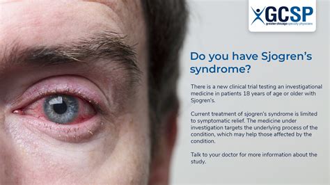 Sjogrens Syndrome Gcsp Greater Chicago Specialty Physicians