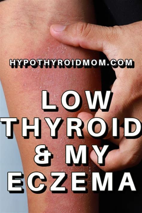 Pin On Hypothyroidism Symptoms