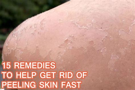 15 Remedies To Help Get Rid Of Peeling Skin Fast