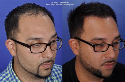 Smartgraft Hair Transplant Before And After Photos Patient 40 Houston