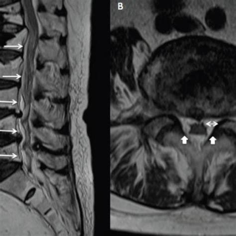 Sagittal And Axial T Weighted Mri Of The Lumbar Spine My XXX Hot Girl