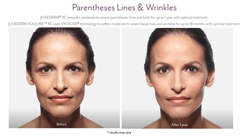 If a patient wants more volume, juvederm ultra is a great choice. Juvederm Dermal Filler New Jersey NJ | Jeffrey Rapaport ...