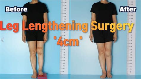 Leg Length Discrepancy Leg Lengthening Surgery Precice Cm Youtube