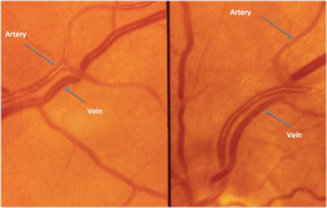 Retinal Vein Occlusions Retina Specialists Victoria