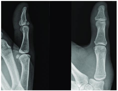 Initial Ap And Lateral View X Rays With The Fracture Fragment Most