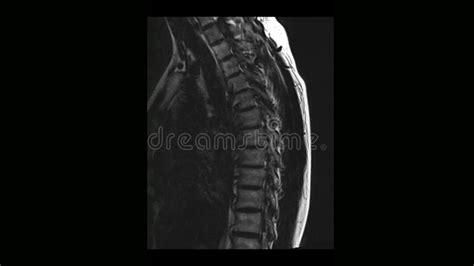 Ct Scan Thoracic Spine Ct With 3d Reconstruction The Film Shown