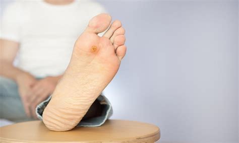 What Increases My Risk Of Diabetic Ulcers On The Foot Midwest