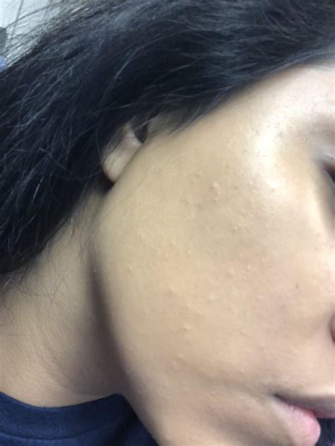 Skin Concern I Have These Bumps All Over My Face And I Dont Know How