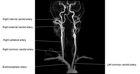 Contain the common carotid artery, internal. CT Anatomy - Neck - wikiRadiography