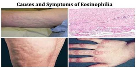 Eosinophilia Assignment Point