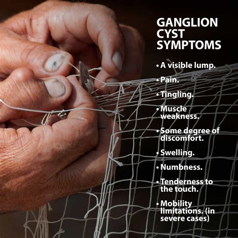 Ganglion Cyst Treatment Florida Orthopaedic Institute