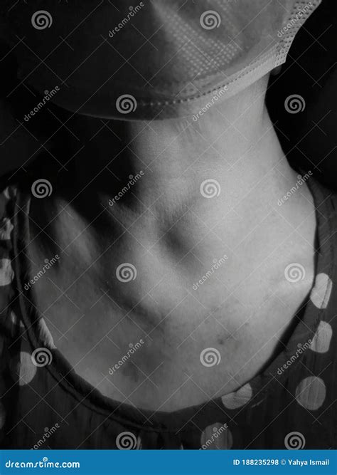 Lvlack And White Image Of Huge Goitre In Asian Lady Stock Photo Image