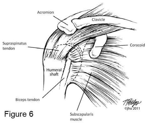 Failed Rotator Cuff Repairs Johns Hopkins Shoulder And Elbow Surgery