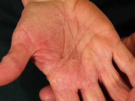 View 37 Dyshidrotic Eczema Stress Rash On Hands