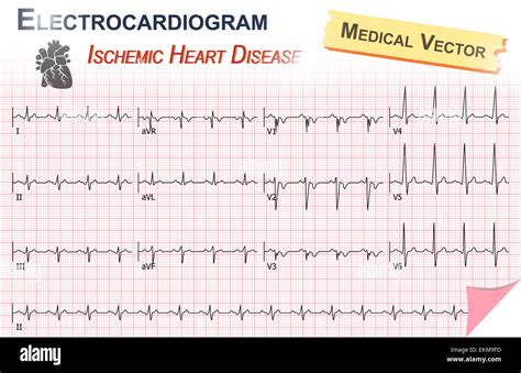 Electrocardiogram Ecg Ekg Of Ischemic Heart Disease Myocardial