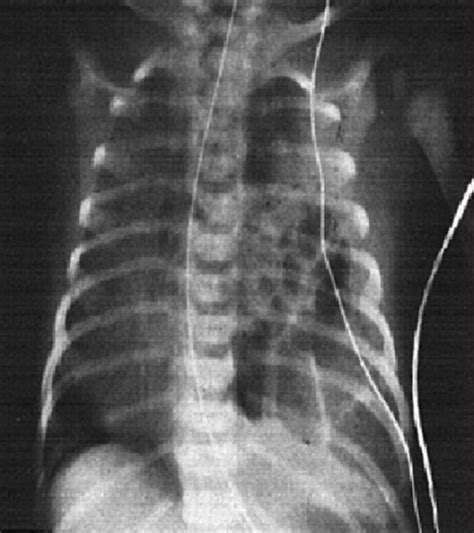 Congenital Diaphragmatic Hernia Chest Radiograph Of Infant With