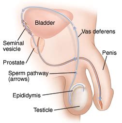 More images for how long for vasectomy to work » Vasectomy Reversal