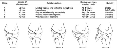 Pediatric Lateral Condyle Humerus Fracture Review Epomedicine