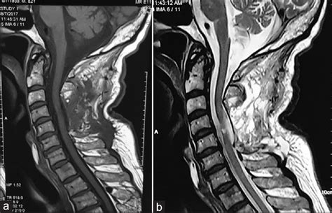 Ct has largely been replaced by mr imaging for the diagnosis of ligamentum flavum, pedicle, transverse process, or vertebral body. Ossification of the cervical ligamentum flavum and case ...